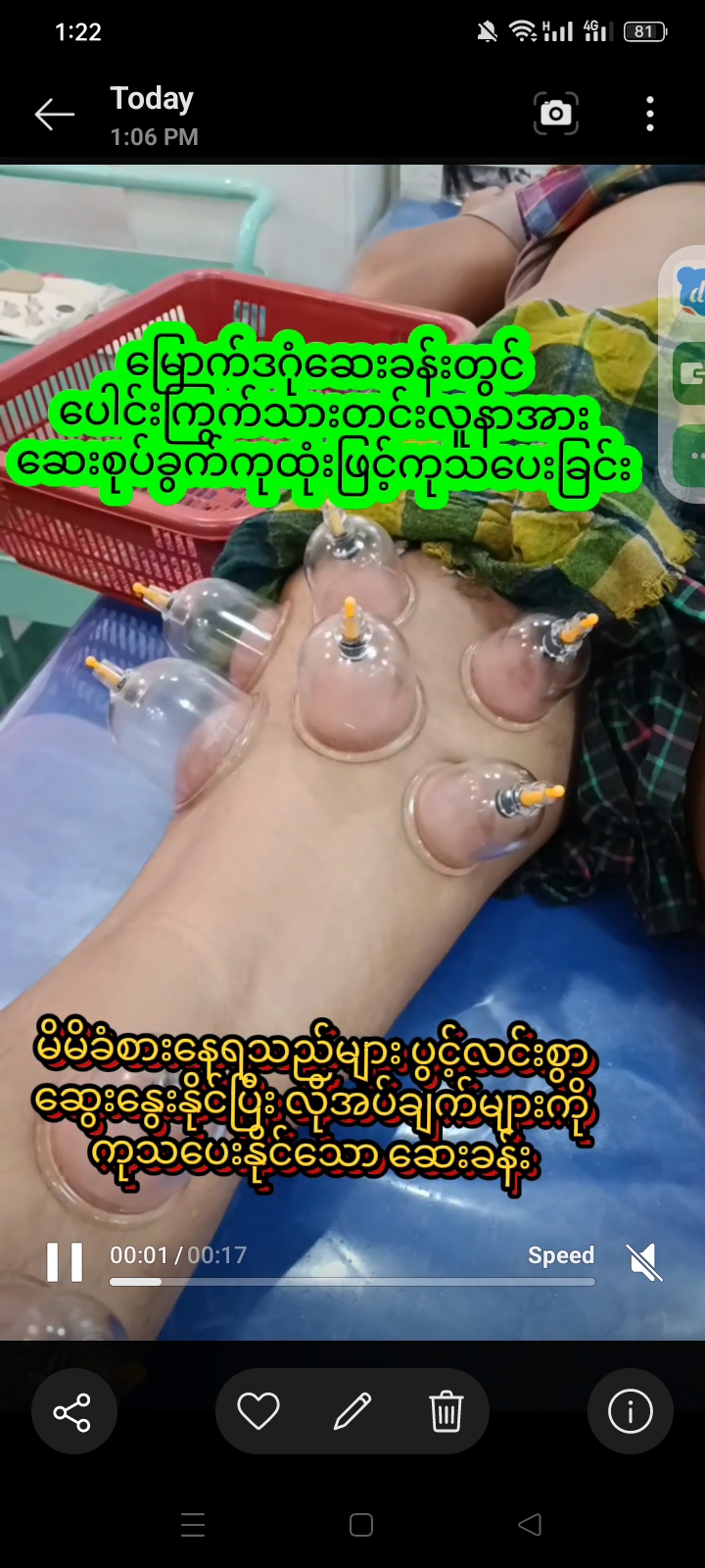 မြောက်ဒဂုံဆေးခန်းတွင်ပေါင်ကြွက်င်ကြွက်သားတင်းလူနာအားဆေးစုပ်ခွက်ကုထုံးဖြင့်ကုသပေးခြင်း