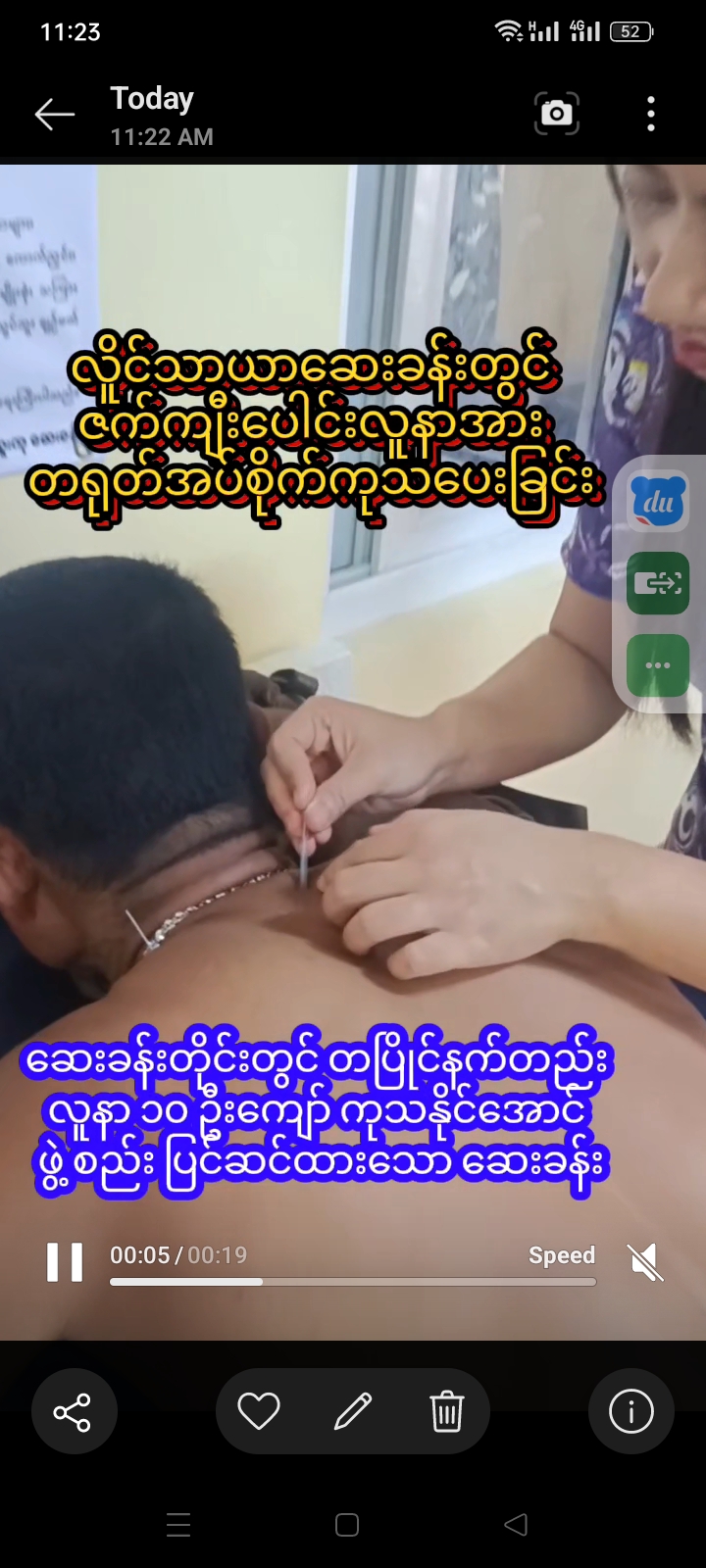လိူင်သာယာဆေးခန်းတွင် ဇက်ကျီးပေါင်းလူနာအား တရုတ်အပ်စိုက်ကုသပေးခြင်း